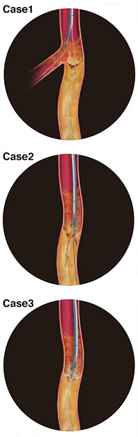 Schematic Explanations of the Clinical Use