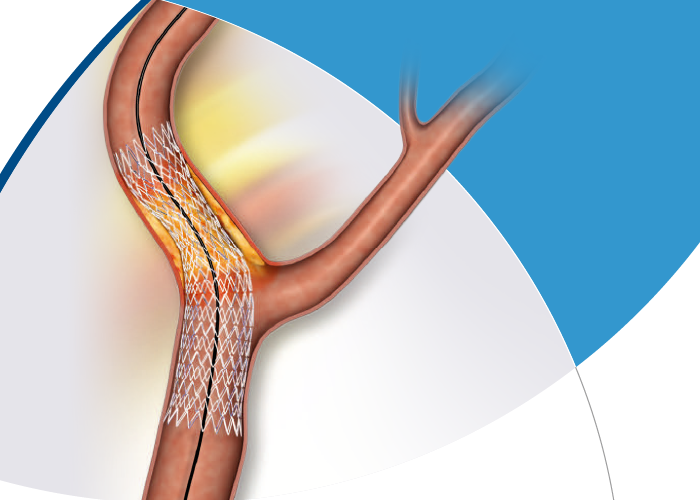 頸動脈用プリサイス