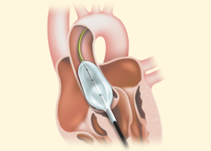 カネカ弁拡張用カテーテルW1