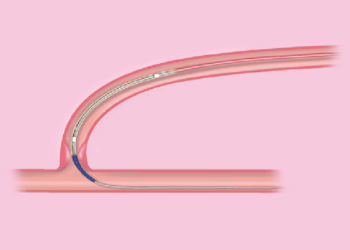 ＰＴＡバルーンカテーテル