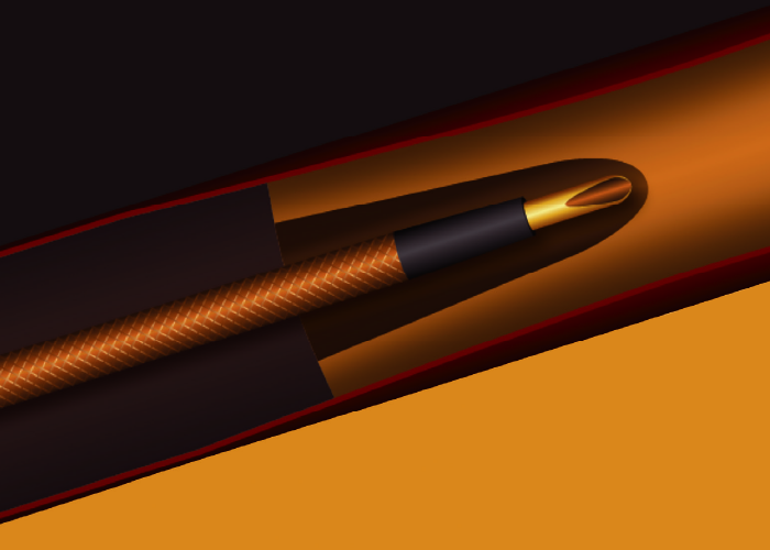 Wingmanカテーテルシステム