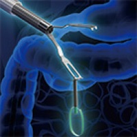 カテーテル一体型けん引クリップ
